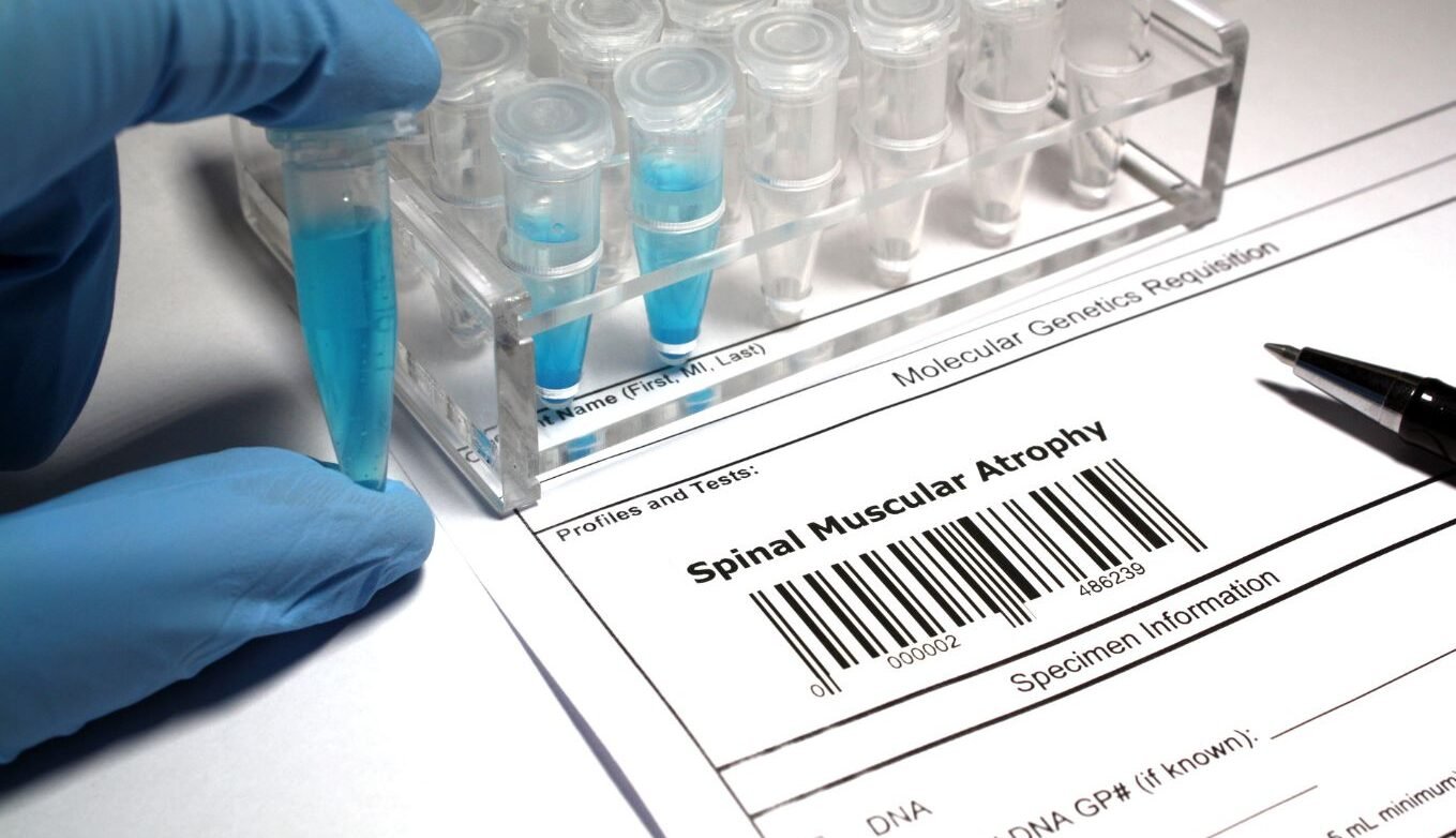 Atrofia-Muscular-Espinal
