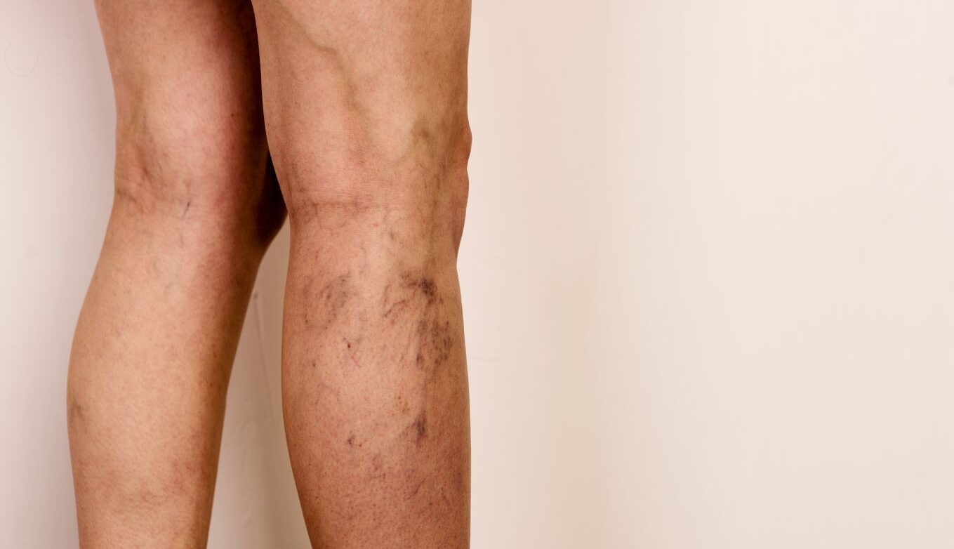 varices pélvicas
