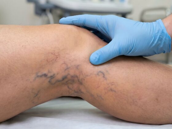 varices